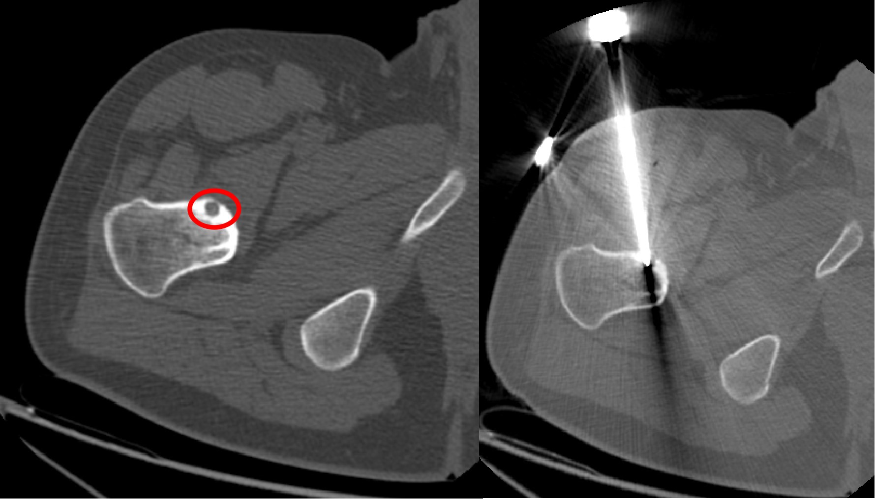 Radiofrequency Ablation For Osteoid Osteoma Dr Anuj Thakral